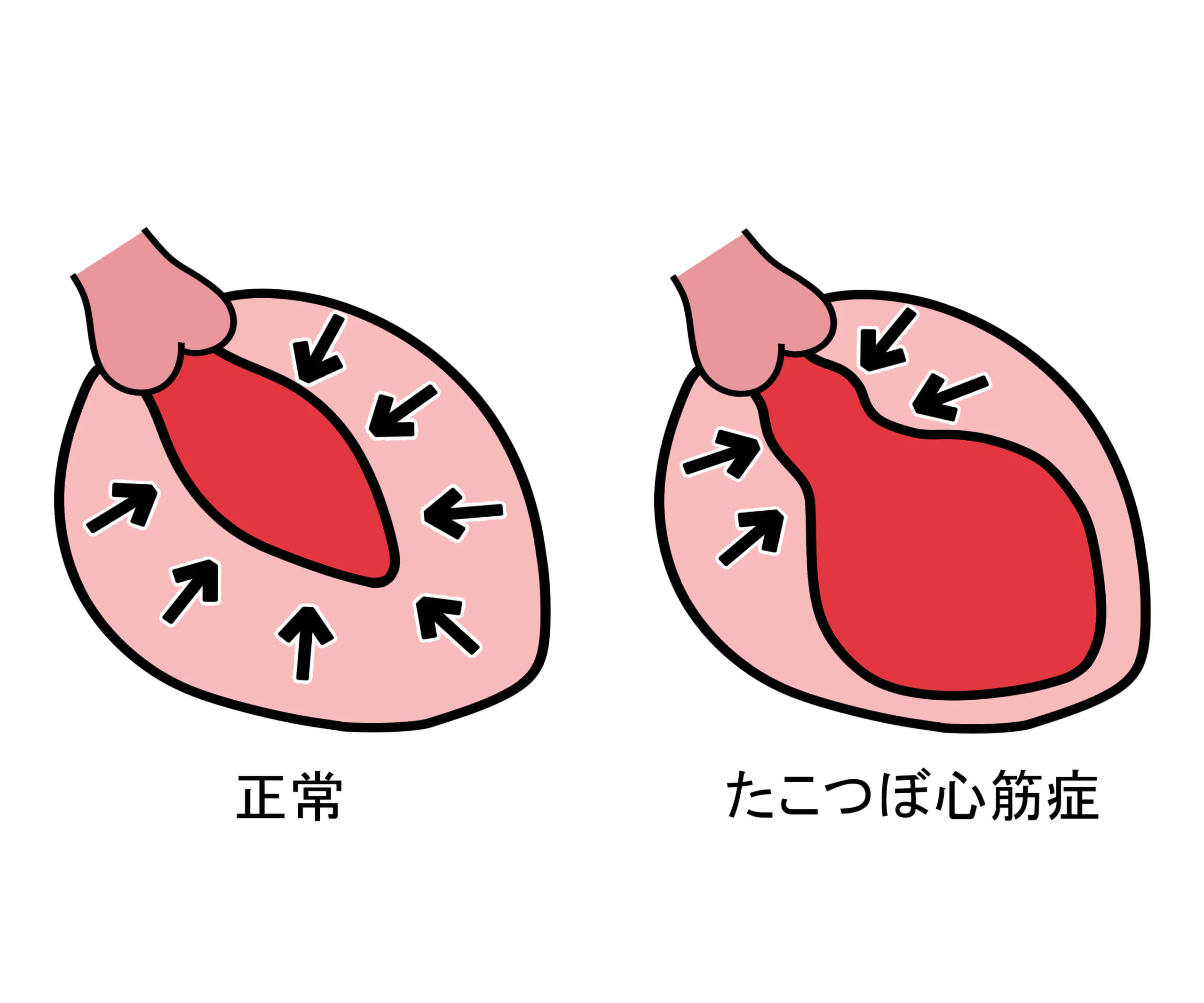 ストレスで心筋症が引き起こされる？たこつぼ心筋症