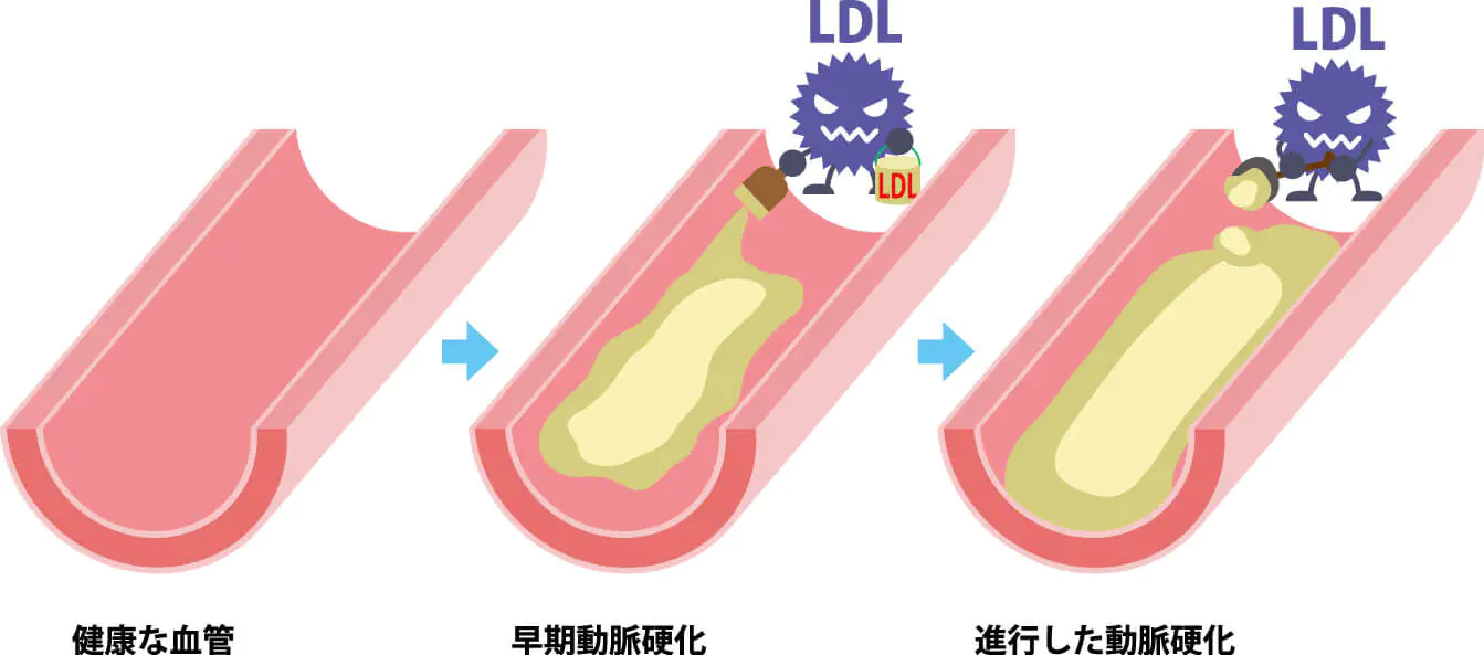 LDL（悪玉）コレステロールが高いとどうなる？