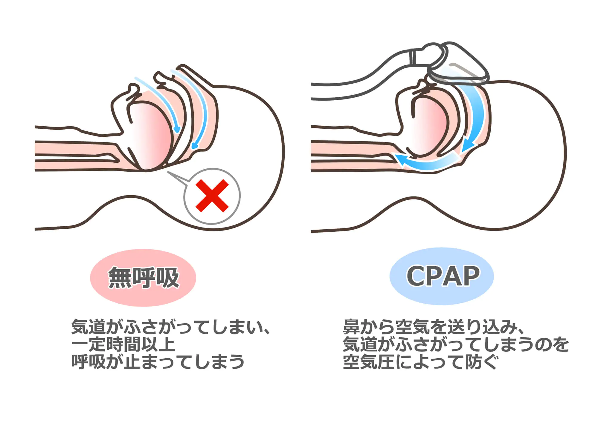 睡眠時無呼吸症候群（SAS）の場合